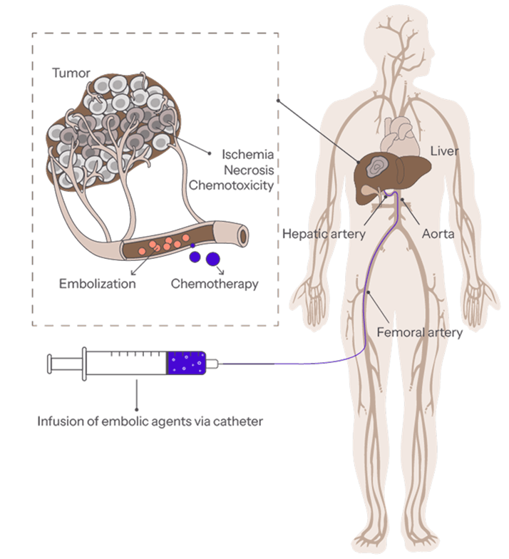 For Patients with Fewer Lesions and Good Liver Function