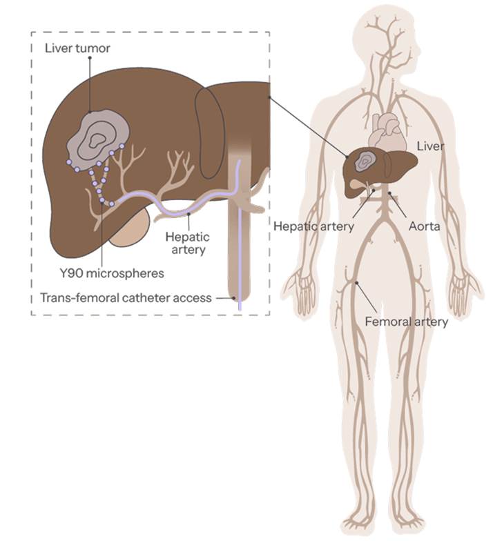 For Patients with Largest Tumors Greater than 5–6 cm