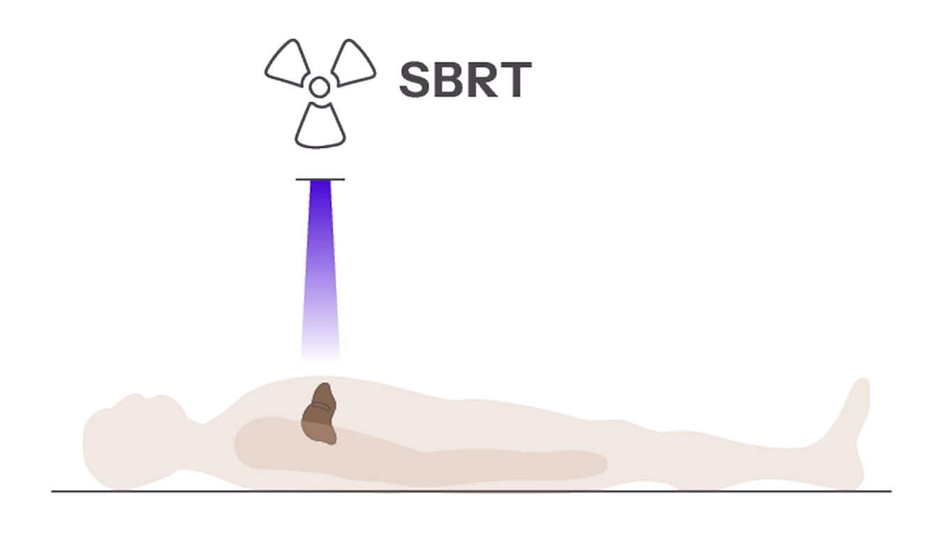For Patients with 1–3 Tumors
